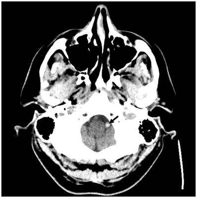 Rescue therapy after thrombectomy for large vessel occlusion due to underlying atherosclerosis: review of literature